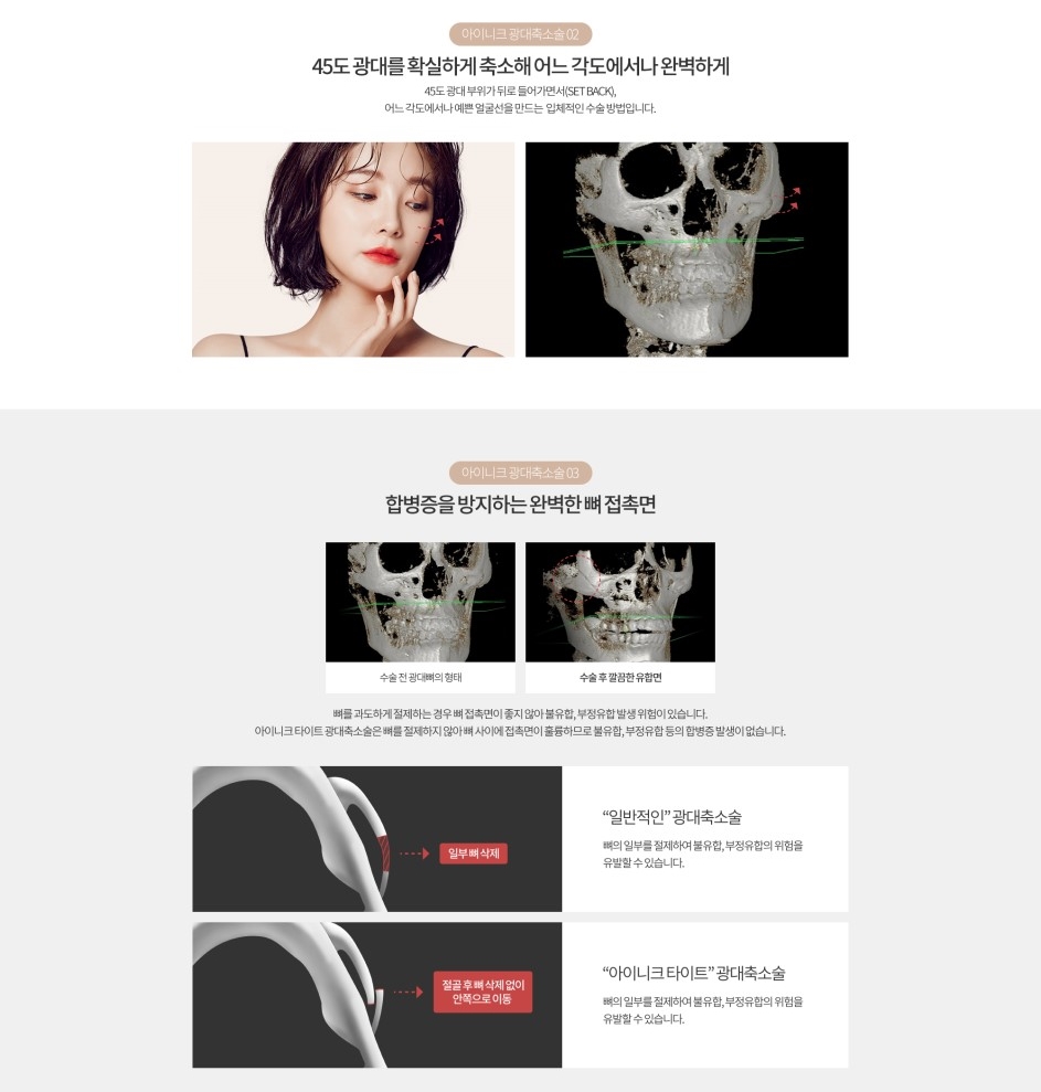광대축소술비용 주의사항은 무엇일까? 관련 이미지 6