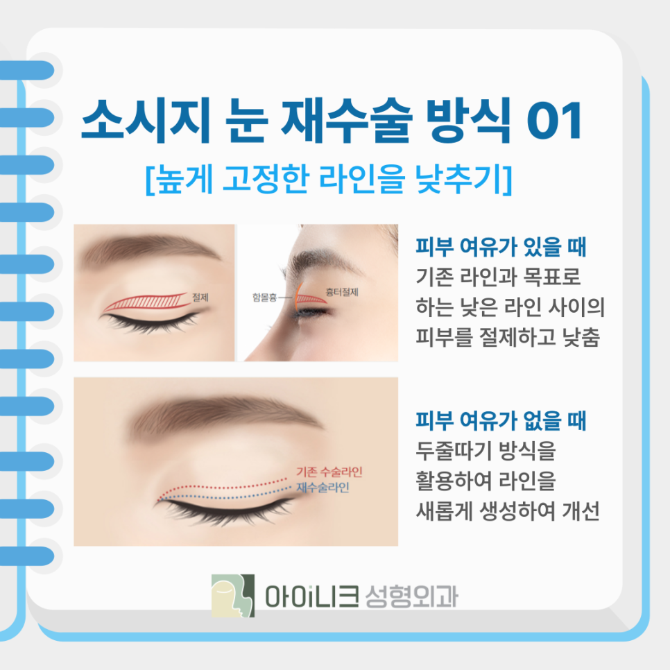 쌍꺼풀재수술비용과 함께 꼼꼼하게 따져야 할 것 관련 이미지 6