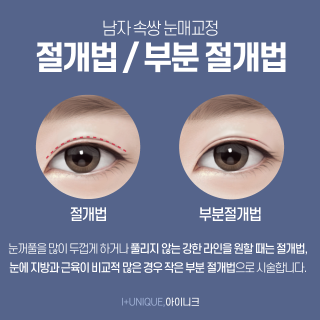 남자쌍수가격이 고민된다면? 관련 이미지 4