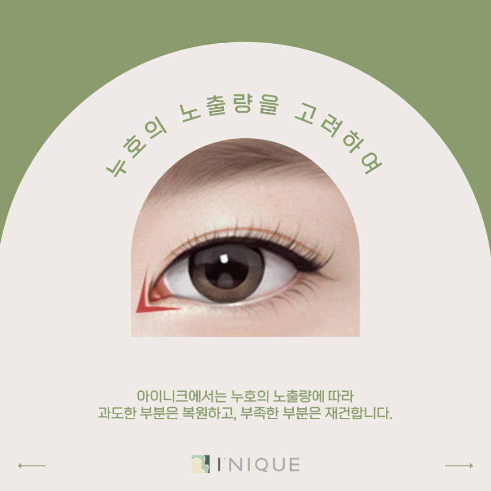 눈재수술잘하는병원, 어떻게 찾을까요? 관련 이미지 5