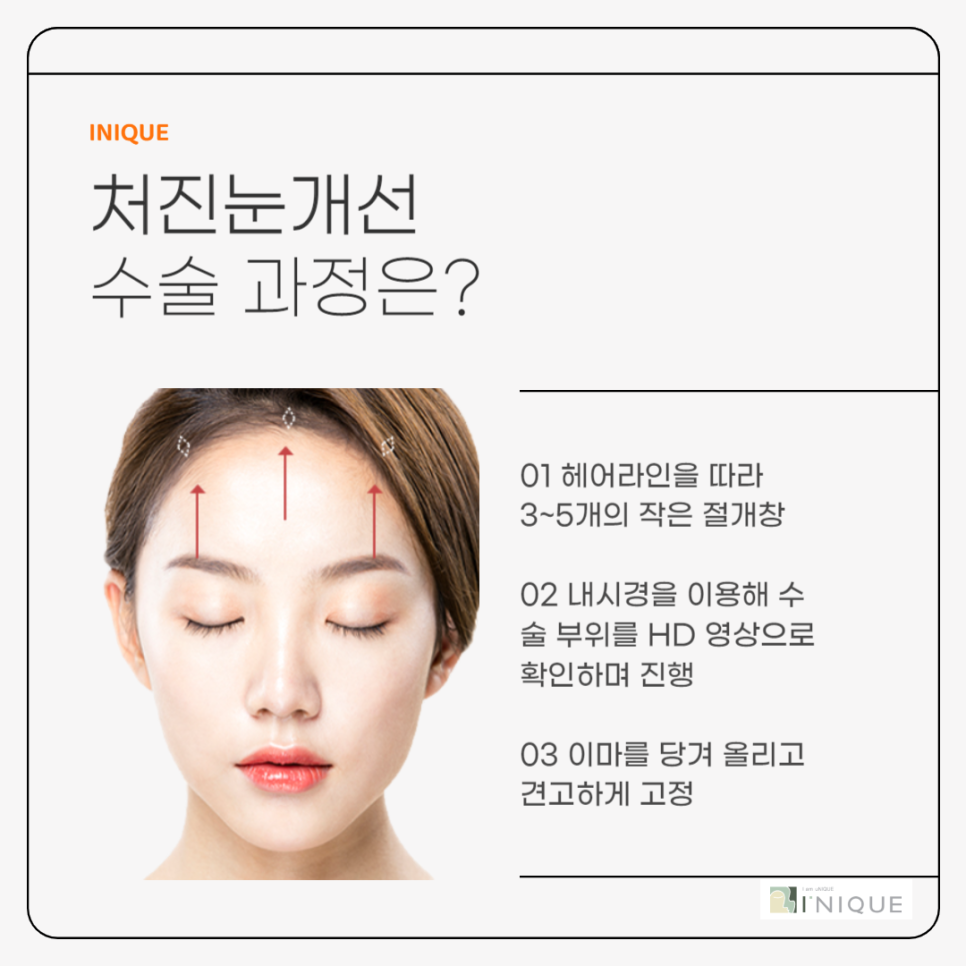 처진눈개선과 빠른 회복을 원한다면 관련 이미지 3