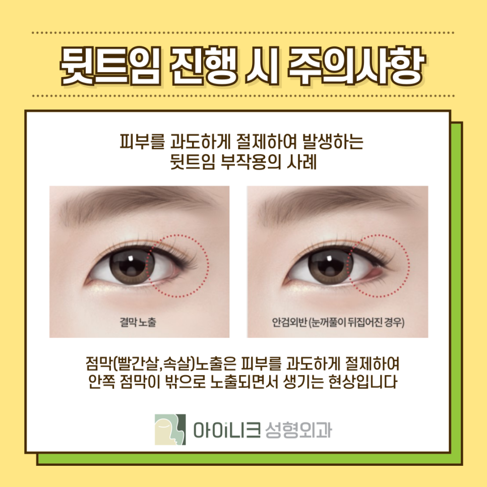 밑트임뒷트임 원하는 눈매에 맞게 진행하기 관련 이미지 8