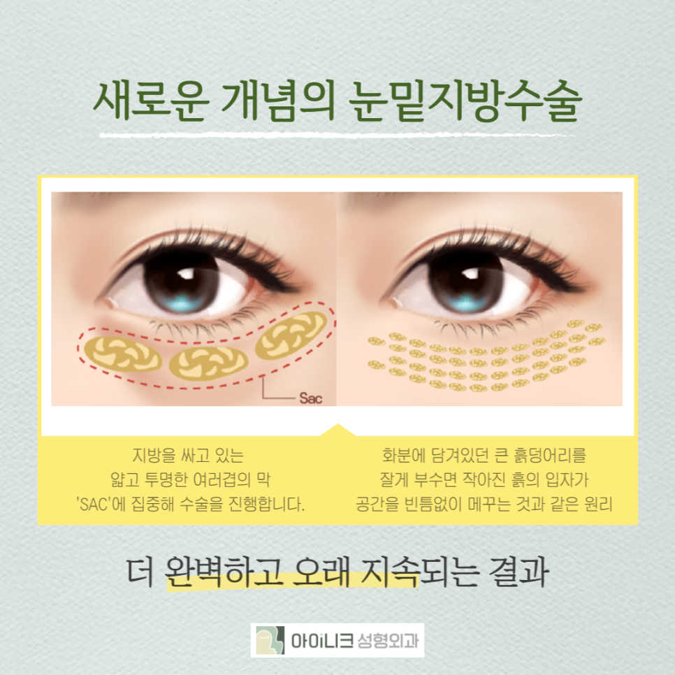 눈밑지방재배치성형외과에서 젊고 자신있게! 관련 이미지 2