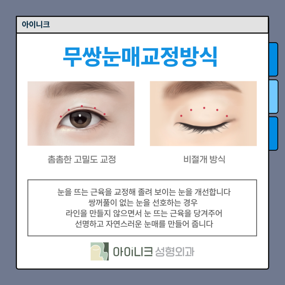 남자눈재수술 어디서 해야 할까? 관련 이미지 8