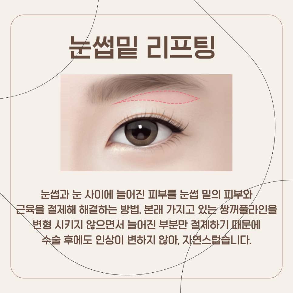 This Method Recommended by iNique Rather Than Upper Blepharoplasty image 4