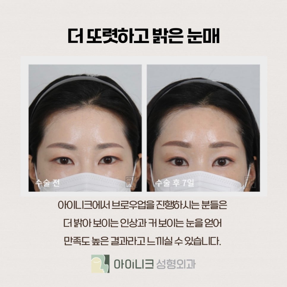 눈썹거상술후기 알아보고 고민될 때 관련 이미지 6