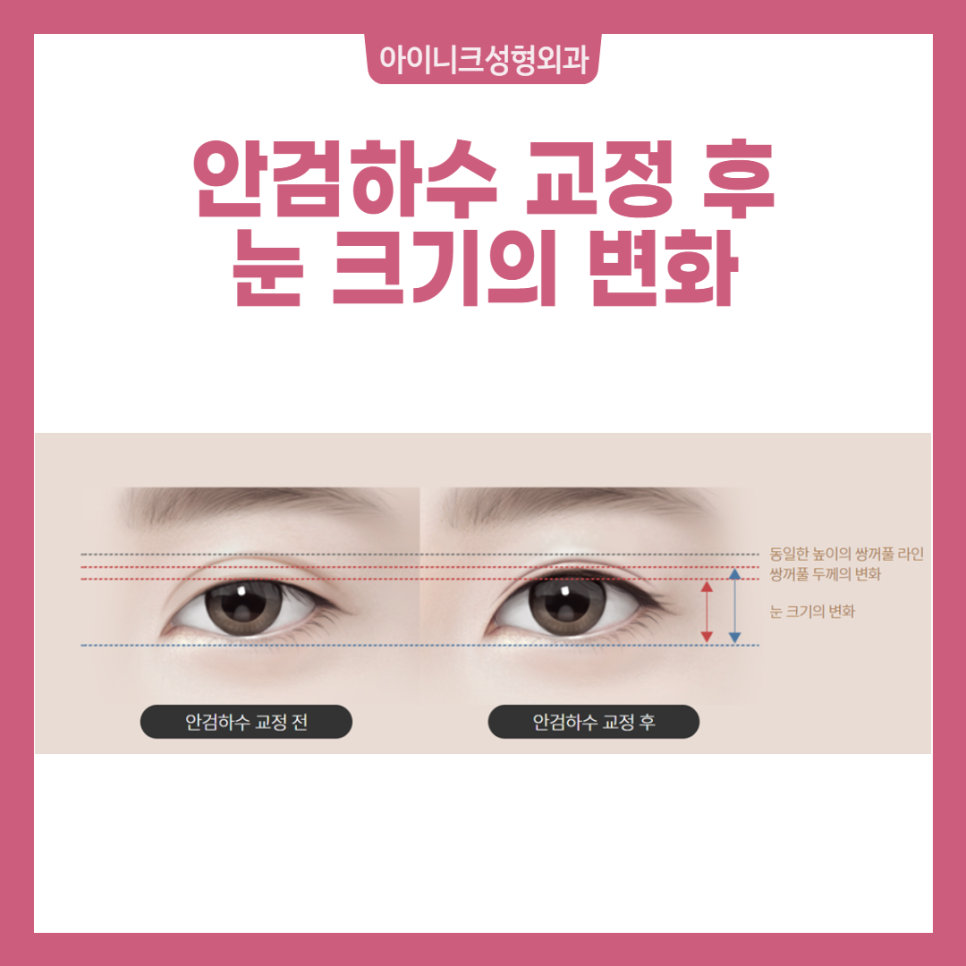Take a Careful Look at an Apgujeong Eye Revision Surgery Clinic! image 4