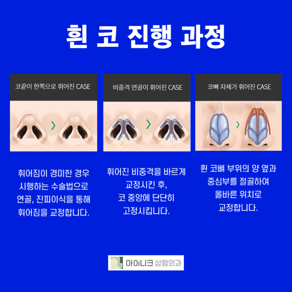 Natural Rhinoplasty with a Personalized Diagnosis image 5