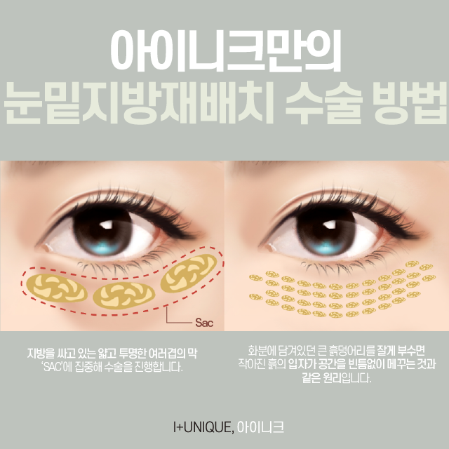 눈밑지방재배치수술 방법, 다른 병원에는 없는 바로 이것! 관련 이미지 2