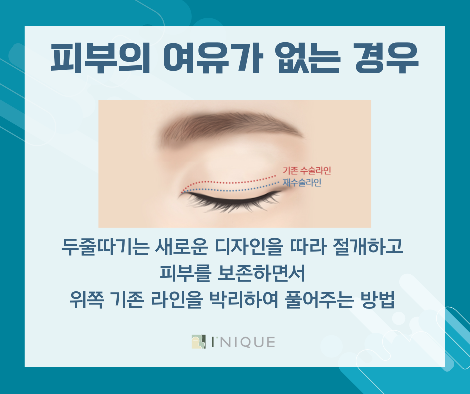 쌍수재수술추천 적절한 시기와 방법 관련 이미지 4
