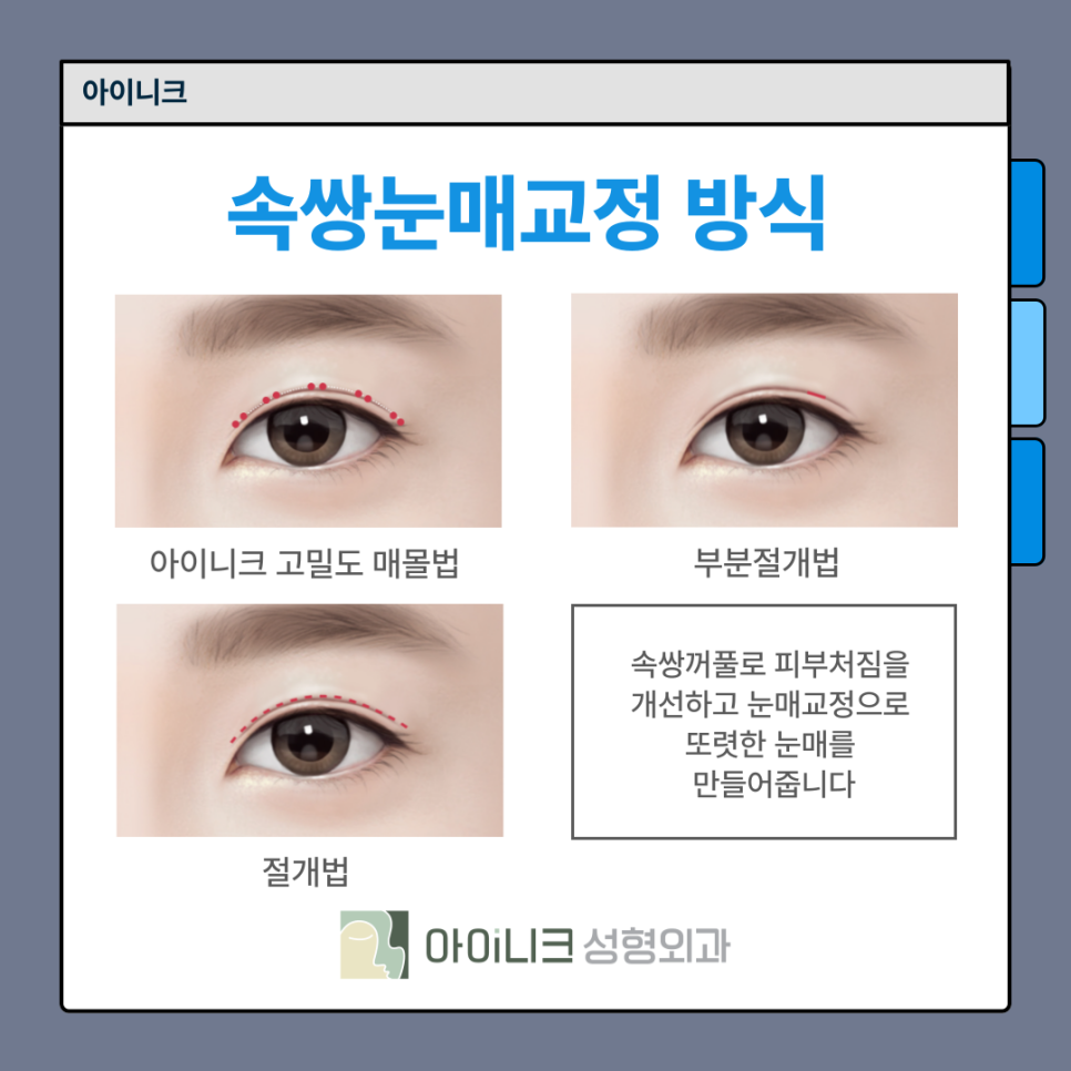남자눈재수술 어디서 해야 할까? 관련 이미지 7