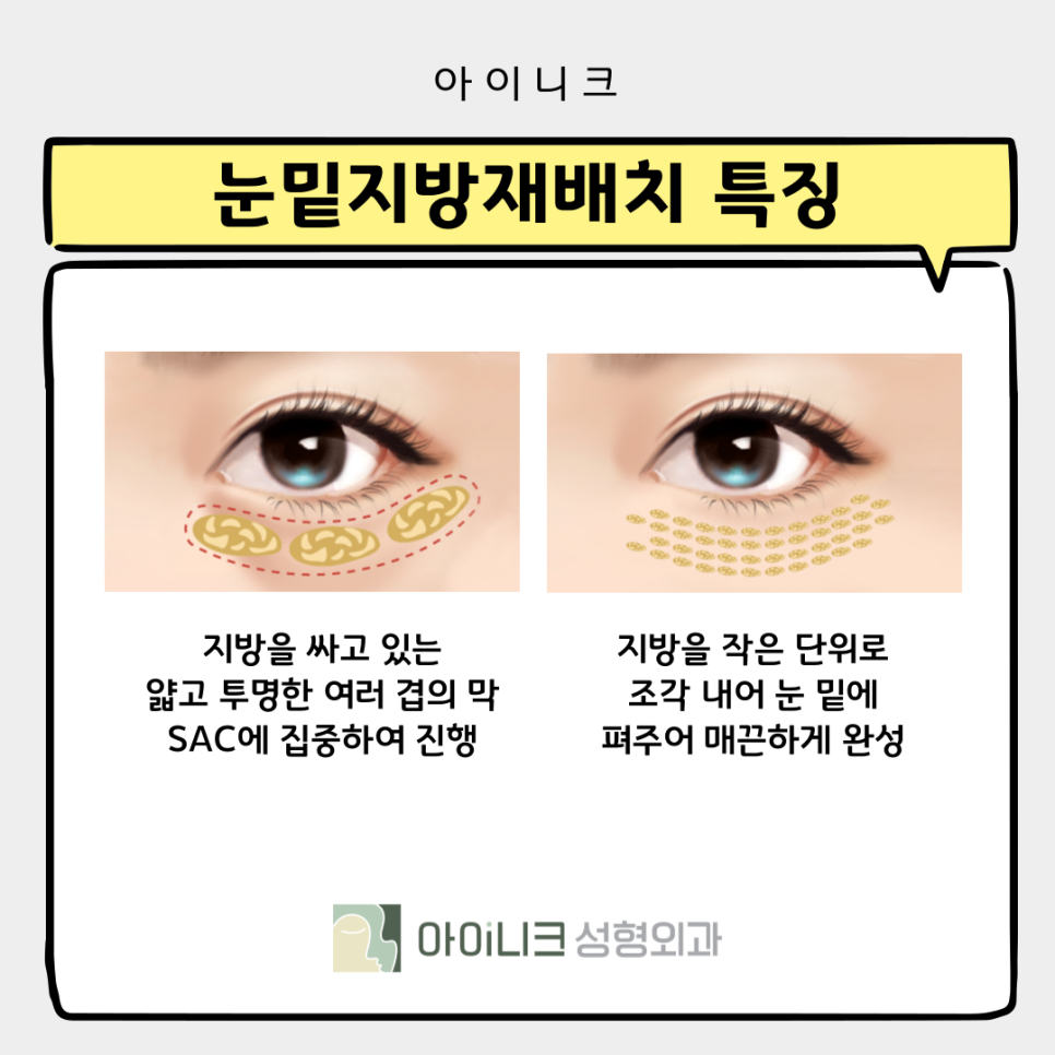 Two Ways to Look 10 Years Younger with Under-Eye Sagging Lifting image 8
