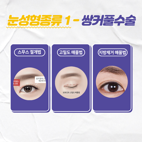 눈성형종류 중에 내게 맞는 방법은? 관련 이미지 2