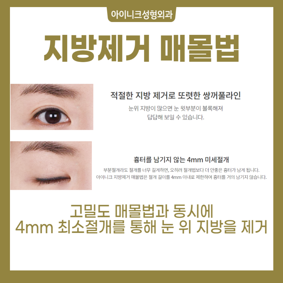 쌍꺼풀병원추천 자연스러움 보장하는 기술력을 갖춘 곳으로 관련 이미지 5