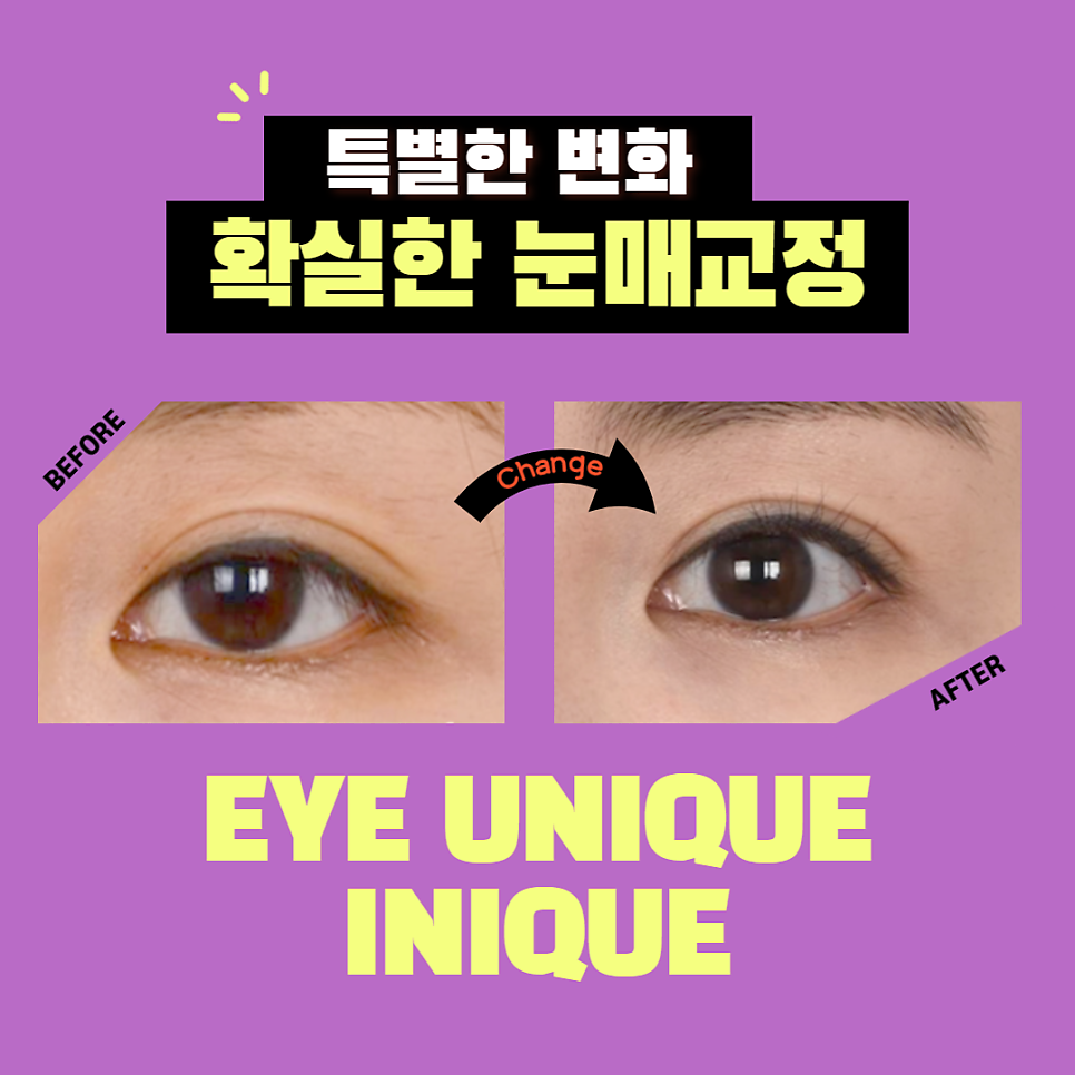 Apgujeong Ptosis: Correct It Without Incision! image 6