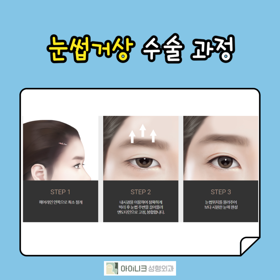 Creating a Clearer Impression with Brow Lift Surgery image 4