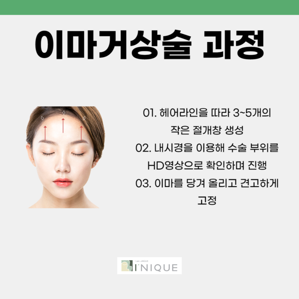 What Is an Endotine Forehead Lift? image 2