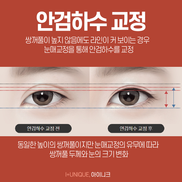 처음만큼 신중해야 하는 쌍꺼풀재수술잘하는병원 고르기 관련 이미지 5