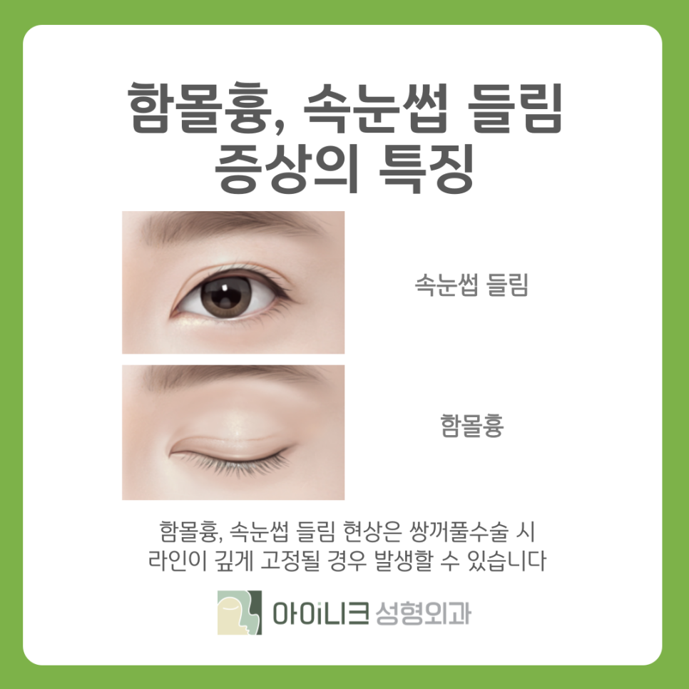 쌍꺼풀흉터 재수술 추천 원인과 해결방법 관련 이미지 6