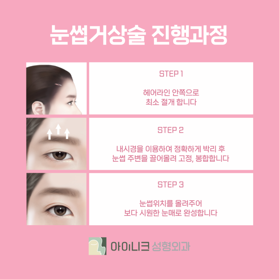 Creating Clear, Defined Eyes with the Gangnam Brow Lift Effect image 5