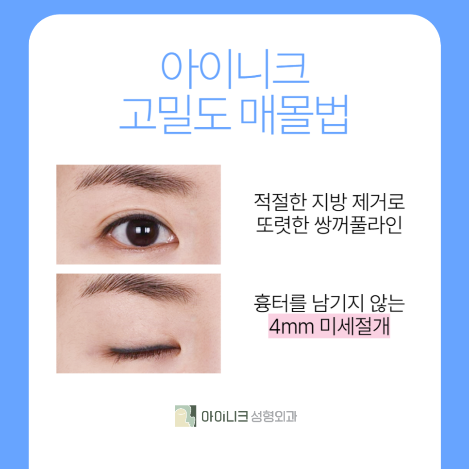 쌍커풀수술잘하는곳 나만의 눈매로 성공했어요 관련 이미지 4