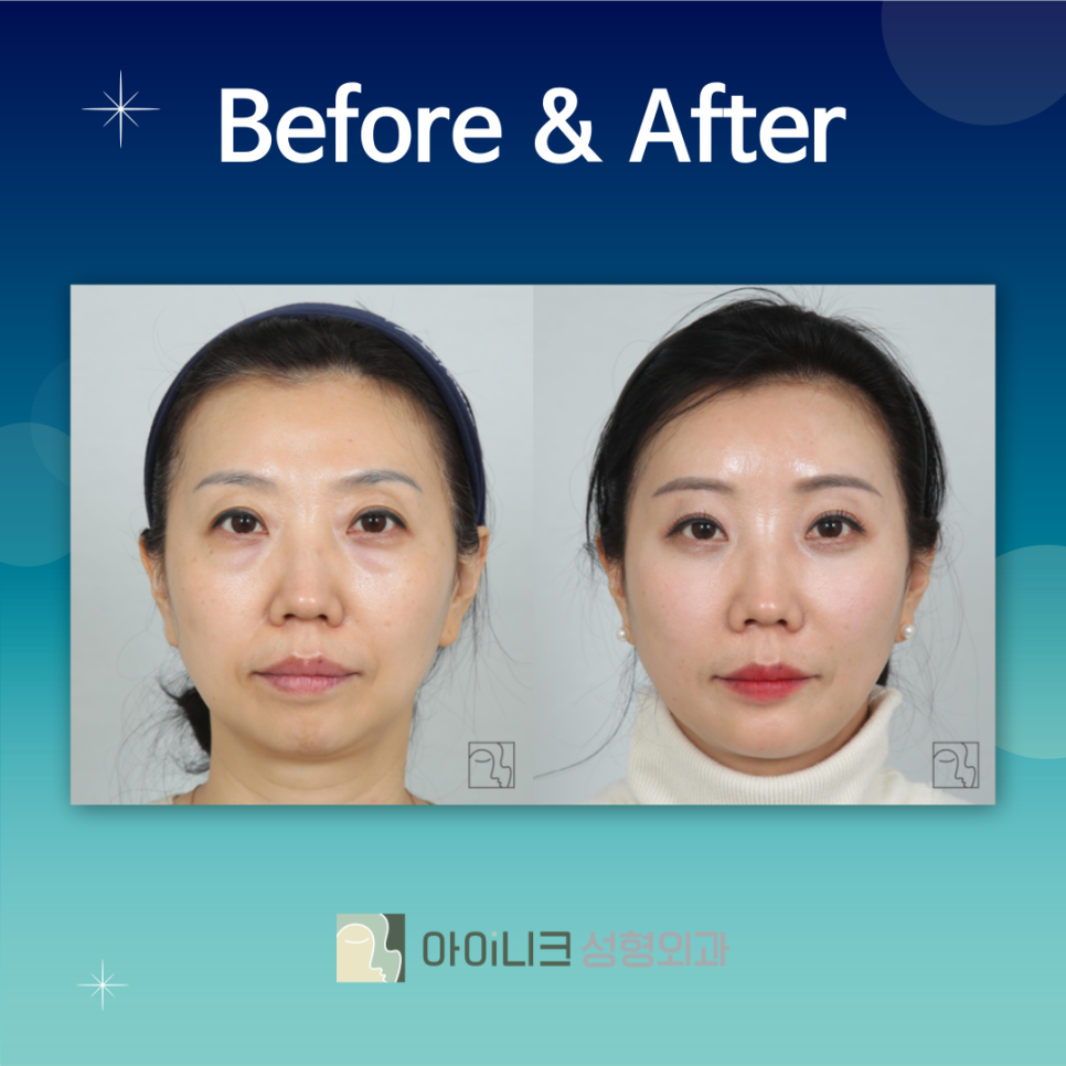 Where Should You Go if You’re 고민 about Under-Eye Surgery in Gangnam, Seoul? image 6