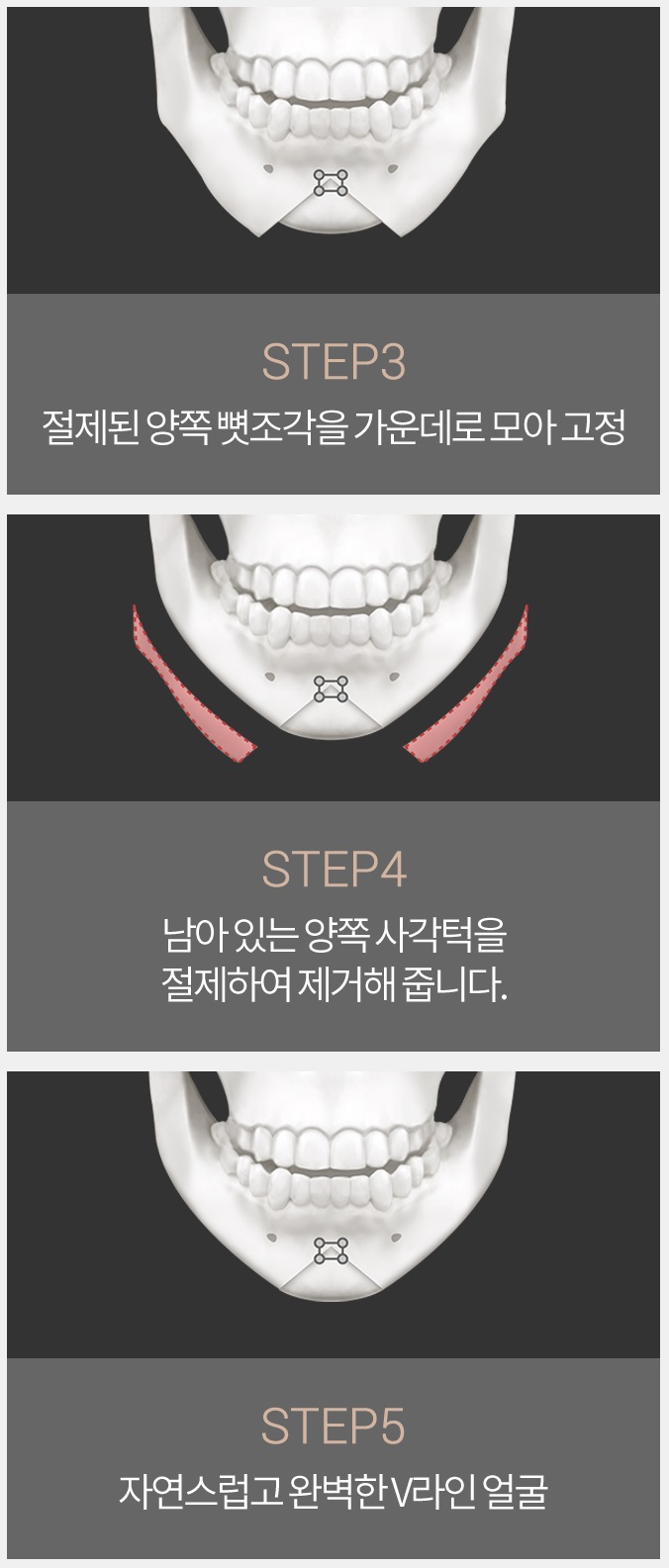 턱끝축소술부작용 없이 안전한 수술 관련 이미지 4
