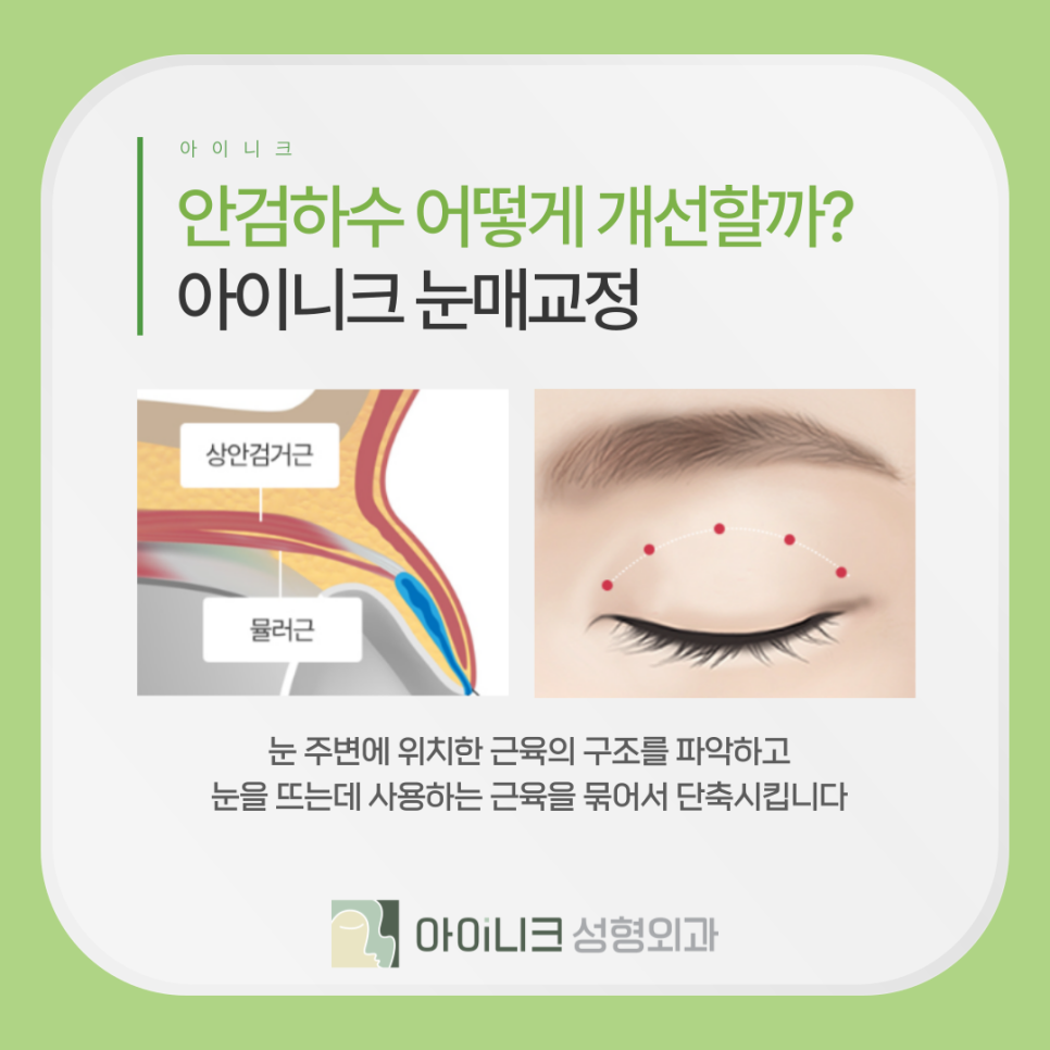 안성형 안검하수 교정, 전후 차이가 이렇게 크다고? 관련 이미지 7
