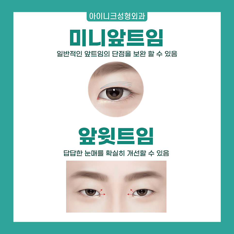 앞트임전후 확실한 인상의 변화를 원한다면 관련 이미지 2