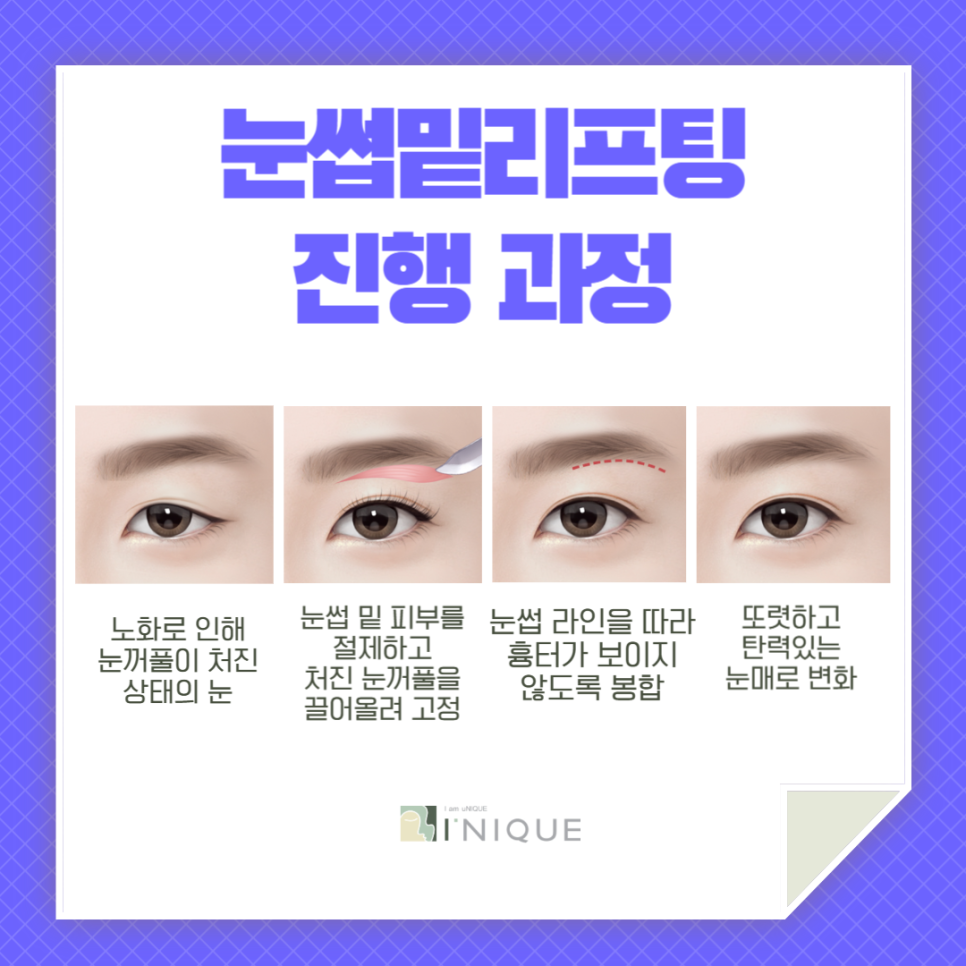 Double Eyelid Surgery in Your 40s, This Is the Perfect Option for Middle Age! image 3