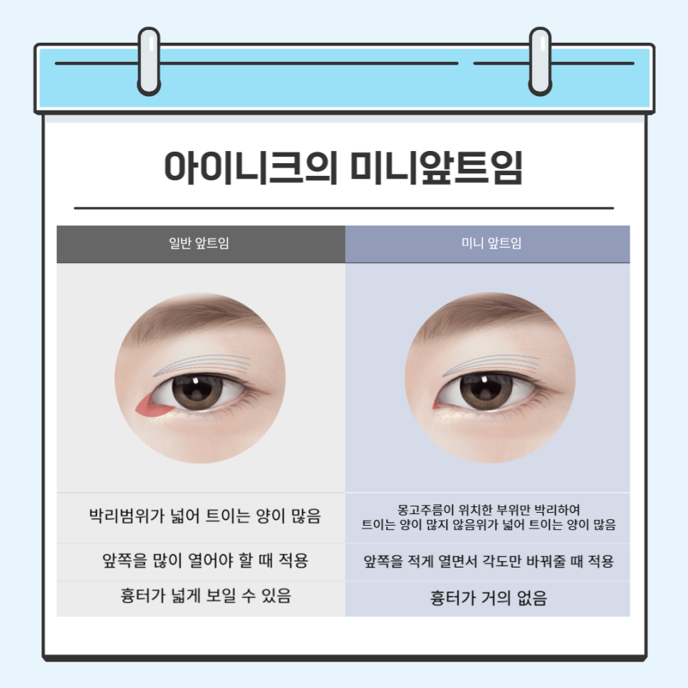 밑트임수술 안전하게 할 수 있는 방법 관련 이미지 3