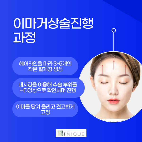 안면거상유명한곳 찾는다면 아이니크성형외과 관련 이미지 4
