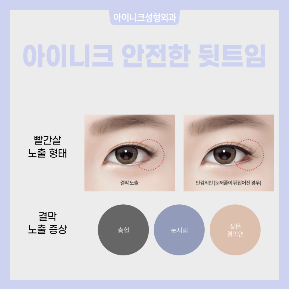 눈트임수술종류 다양하게 알아보고 선택하자! 관련 이미지 6