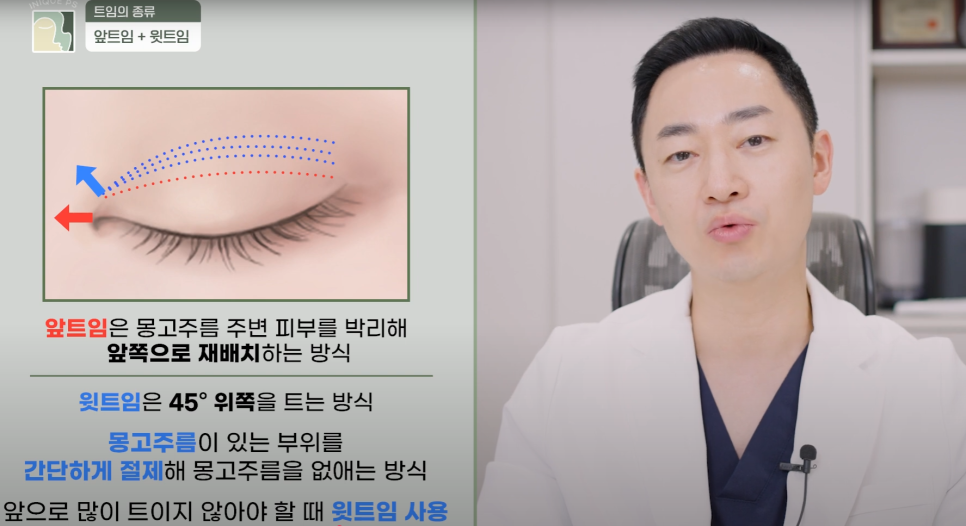Upgraded with Apgujeong Eye Corner Surgery: Eyes That Look Twice as Large! image 5