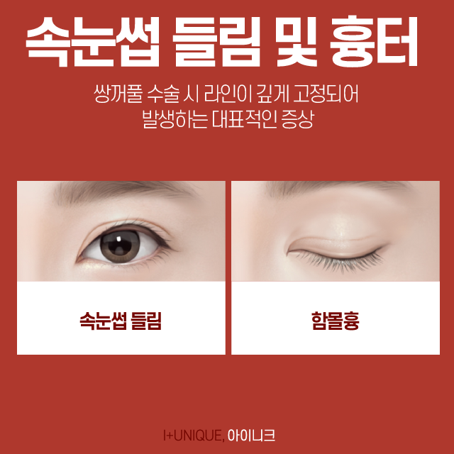 성형눈재수술, 보다 신중한 병원결정이 필요한 이유 관련 이미지 3