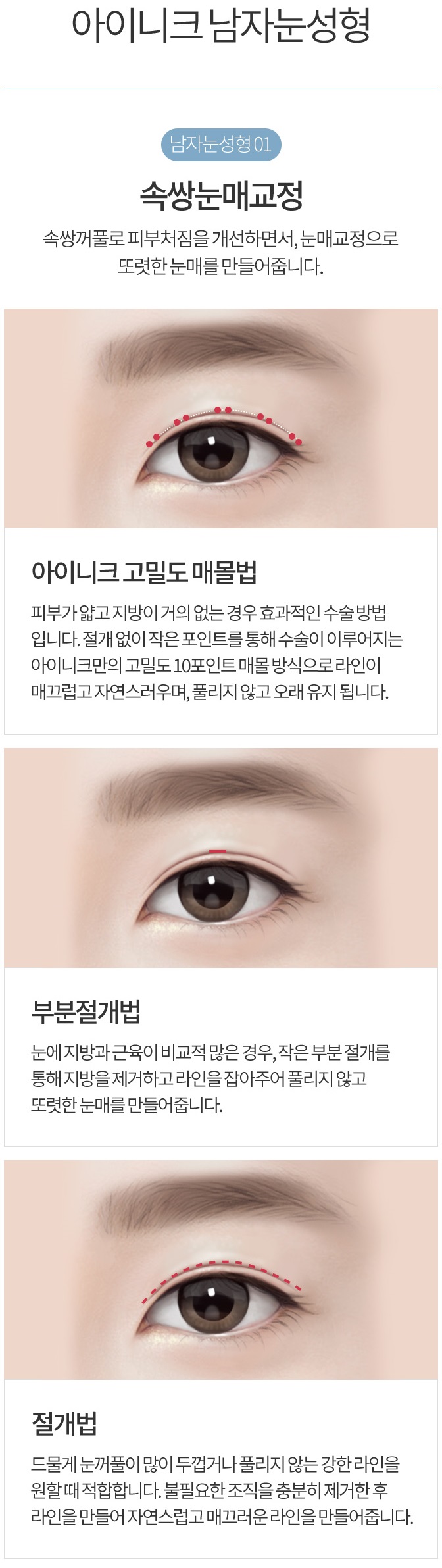 무쌍눈매교정술 쌍꺼풀 없이 큰 눈으로 관련 이미지 3