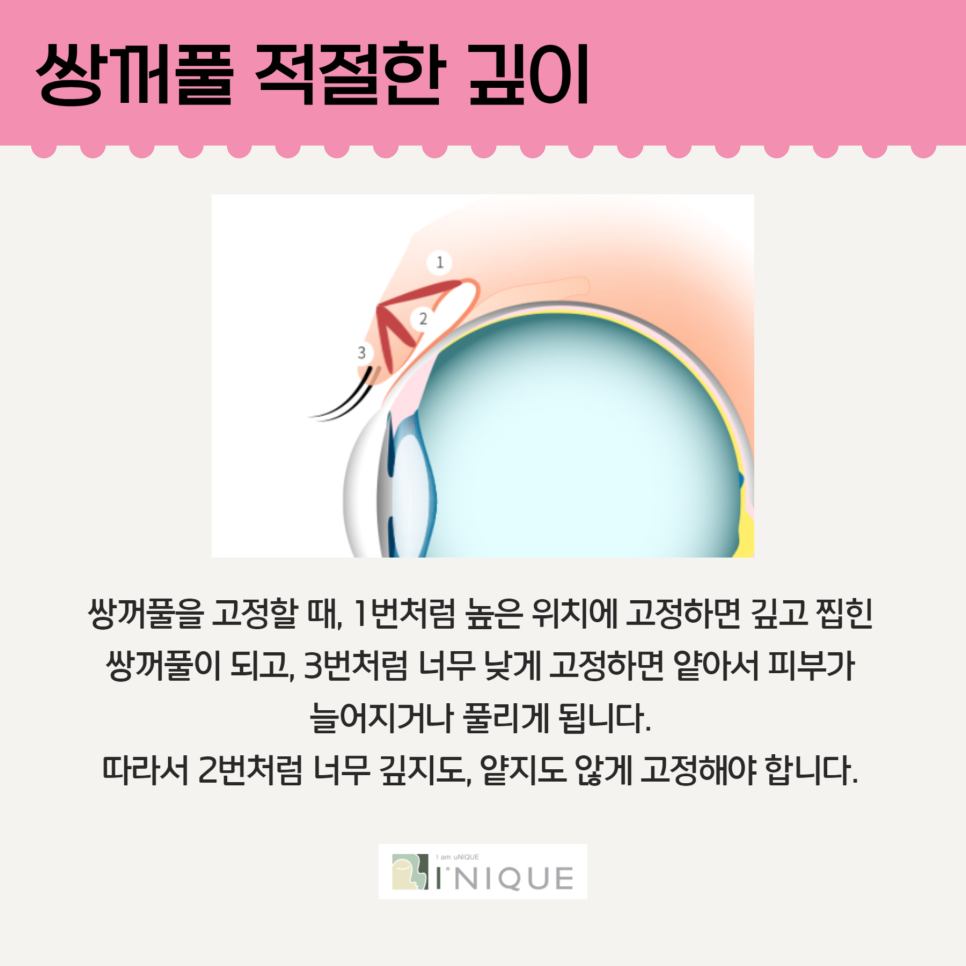 눈성형모델처럼 예쁜 쌍꺼풀 관련 이미지 4