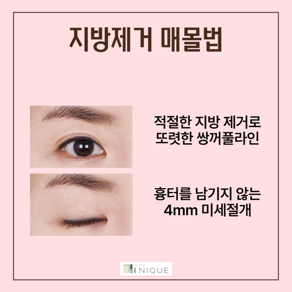 강남쌍꺼풀 자연스럽게 예뻐지는 방법 관련 이미지 4