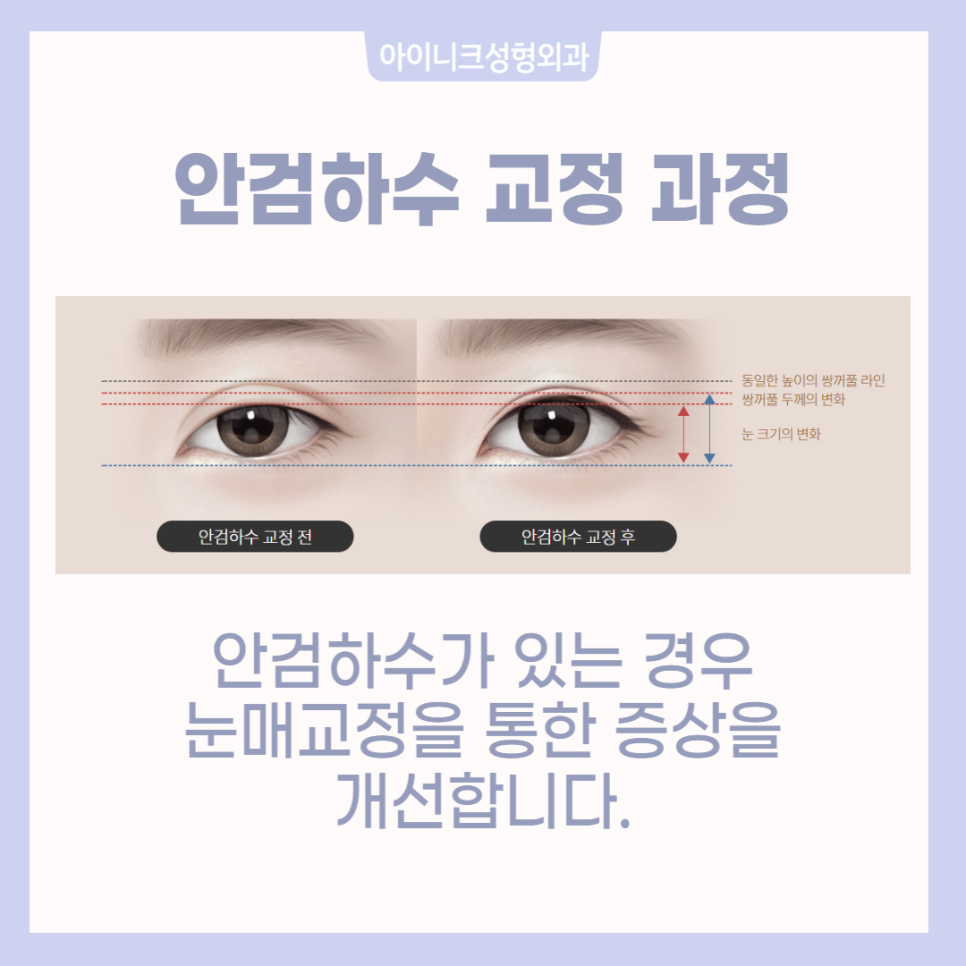 소세지눈재수술로 자연스러움을 되찾는 방법 관련 이미지 4