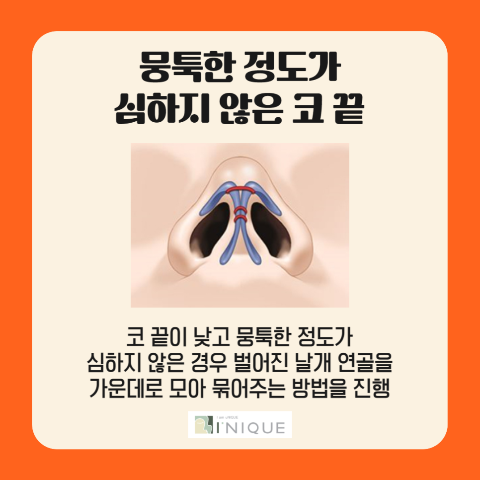 Attention if You're Looking for a Place That Does Nose Tip Surgery Well! image 2