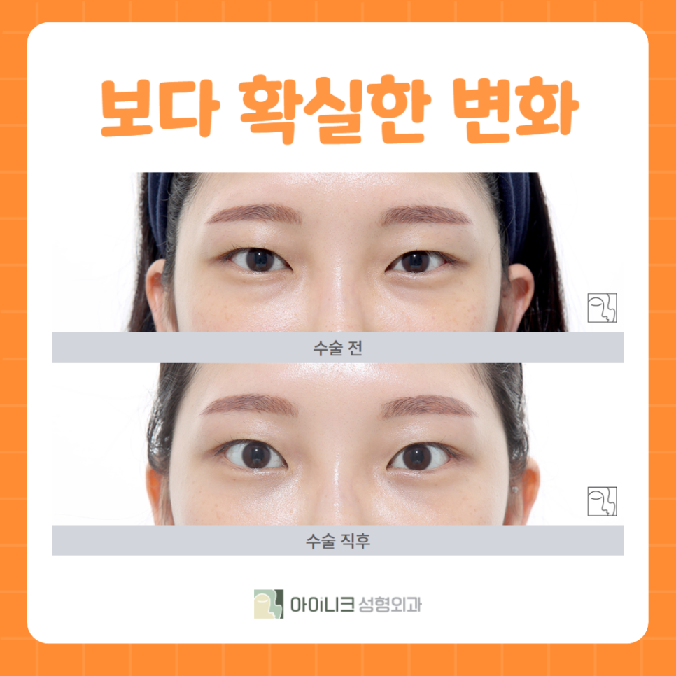 The Difference of Ainic’s Encore Under-Eye Fat Repositioning image 5
