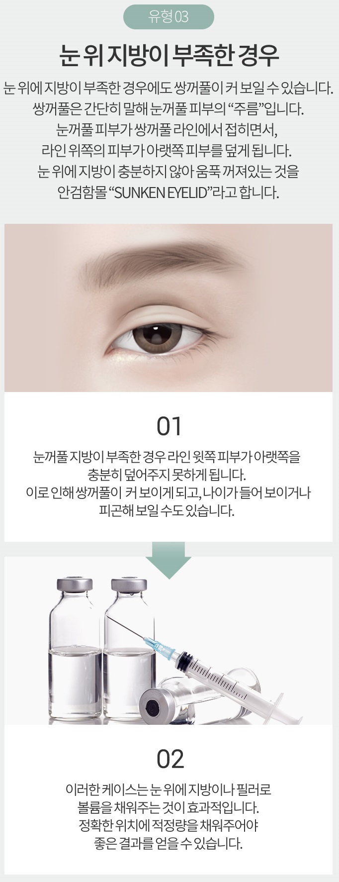 소시지쌍꺼풀 원인부터 파악하자! 관련 이미지 6