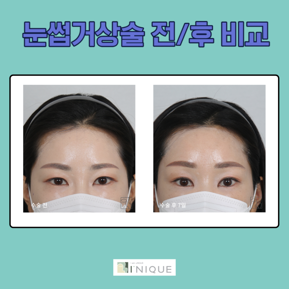 눈썹올림술로 주름 고민 말끔 해결! 관련 이미지 5