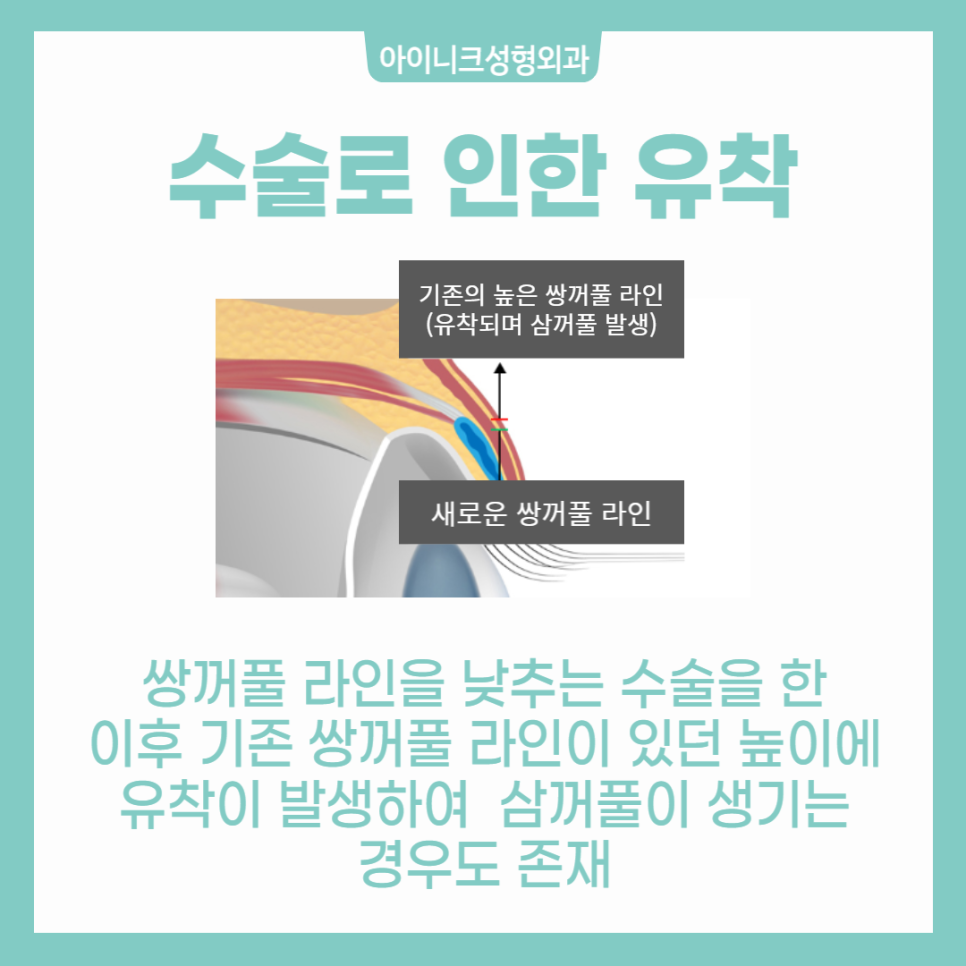 쌍꺼풀 여러겹 해결할 수 있을까? 관련 이미지 6