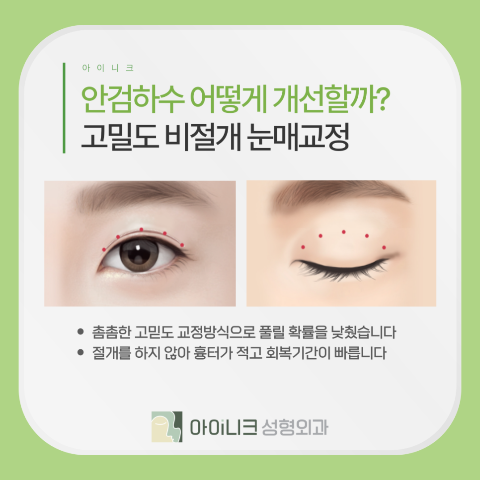안성형 안검하수 교정, 전후 차이가 이렇게 크다고? 관련 이미지 8