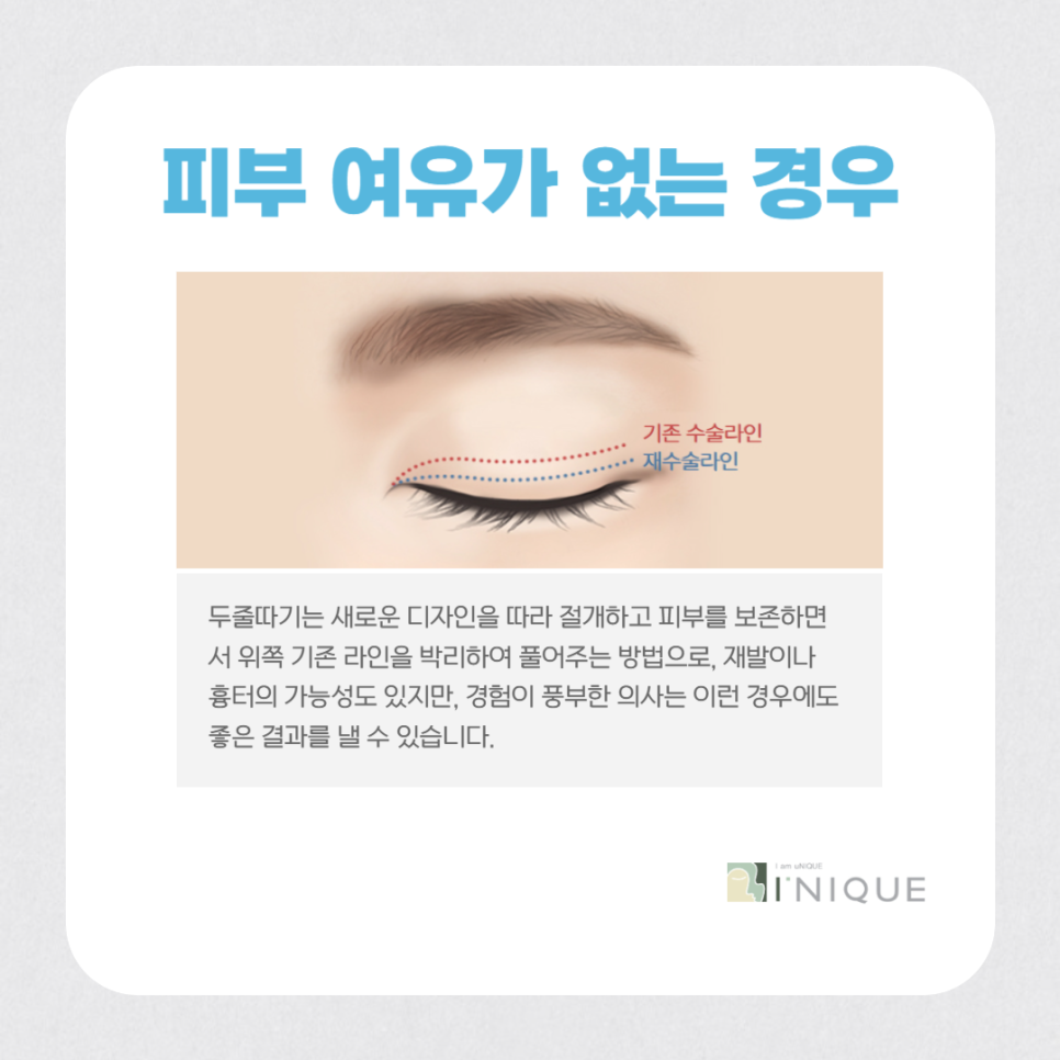 눈성형재수술, 마지막이 되려면? 관련 이미지 5