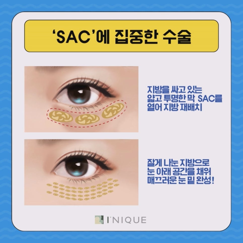 청담동눈밑지 발생 원인은? 관련 이미지 6