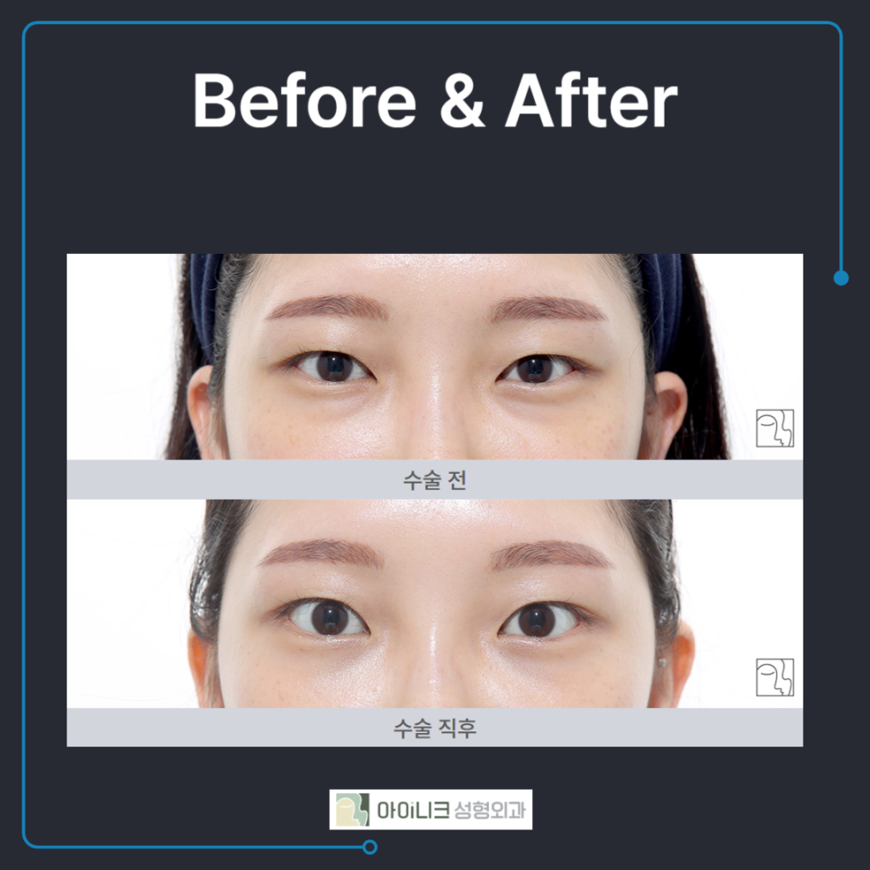 눈밑에주름 확실하게 개선하는 방법 관련 이미지 5