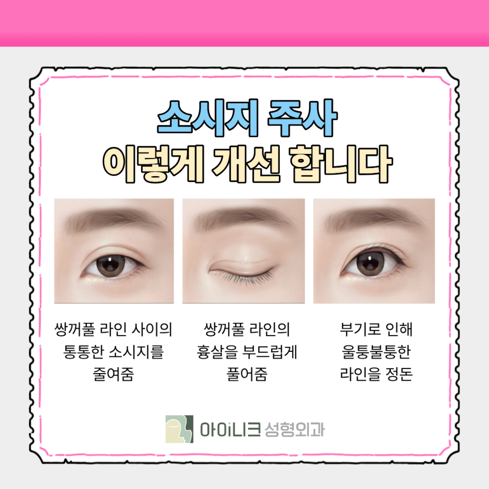 압구정 눈성형외과 소시지 주사로 바쁜 사람도 OK 관련 이미지 7