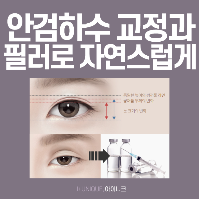 No More Failures! Get a Consultation on Revision Double Eyelid Surgery and Cost image 4